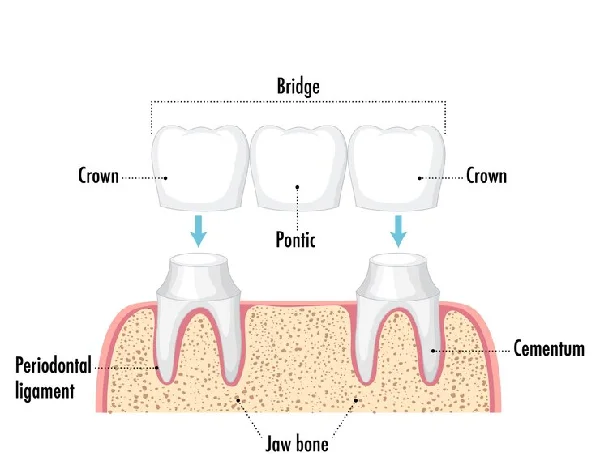Crowns And Bridges